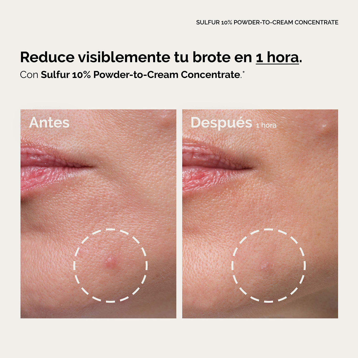 SULFUR 10% POWDER-TO-CREAM CONCENTRATE (CONCENTRADO DE AZUFRE AL 10% EN TEXTURA POLVO A CREMA PARA DISMINUIR BROTES)